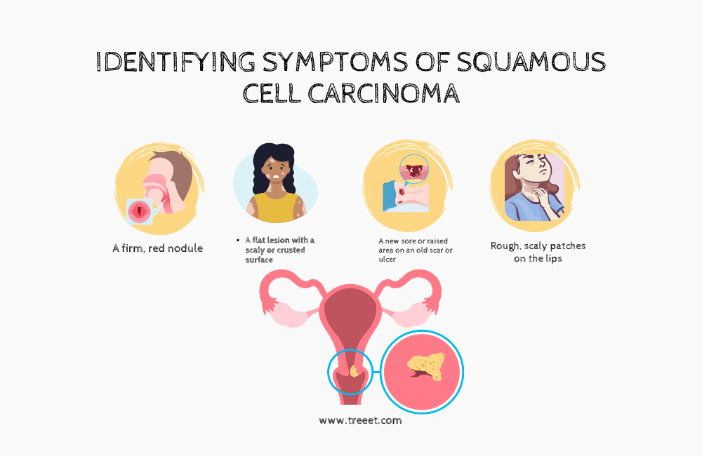 an illustration of a Symptoms of Squamous Cell Carcinoma