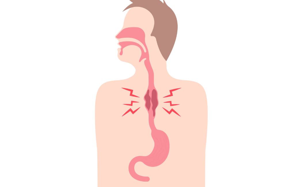 an illustration of a squamous cell carcinoma. 